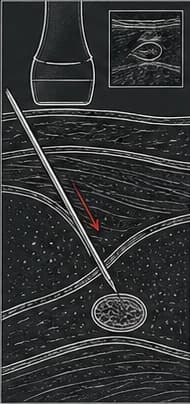 Dark clinical reconstruction panel showing a needle inserted through tissue under ultrasound guidance.