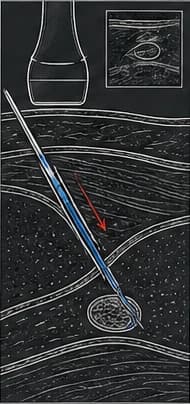 Dark clinical reconstruction panel showing a blue catheter advanced through a needle toward a target nerve.