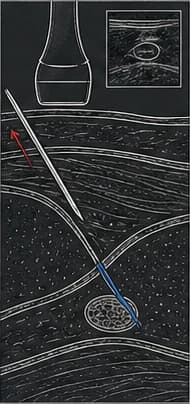 Dark clinical reconstruction panel showing the needle being withdrawn while a blue catheter remains in tissue.