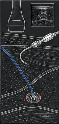Dark clinical reconstruction panel showing a catheter connector and an illustrated deployed anchor near the target.