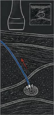Dark clinical reconstruction panel showing the catheter moving away from the target in an intended-removal scenario.